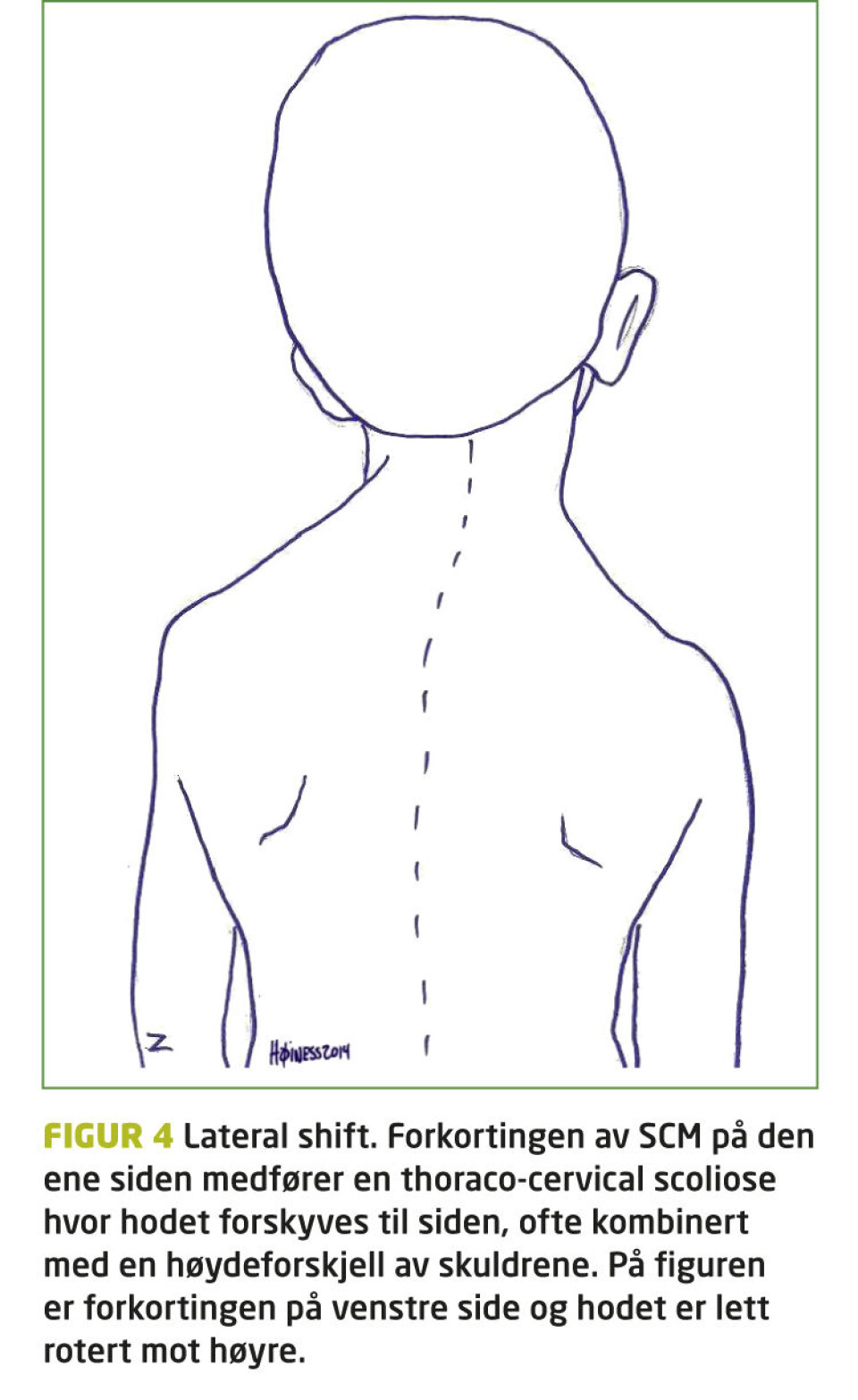 Kirurgisk behandling av medfødt muskulær torticollis. Når skal vi henvise?
