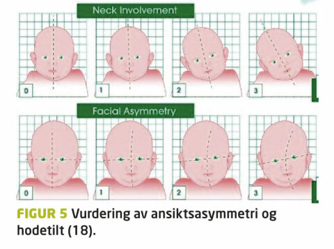 Torticollis behandling