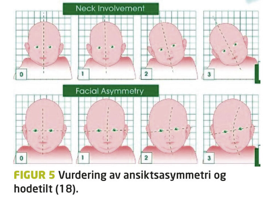 Kirurgisk behandling av medfødt muskulær torticollis. Når skal vi henvise?