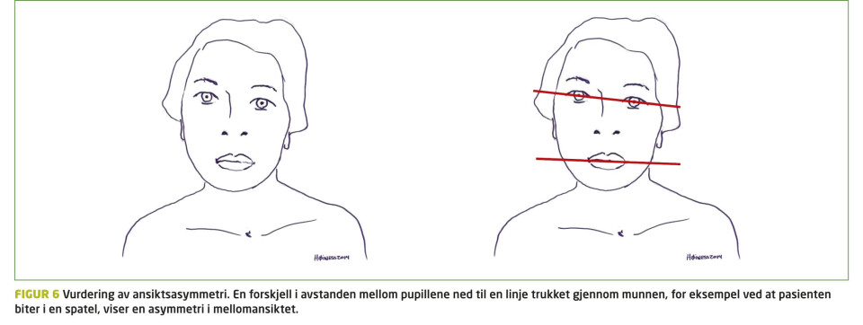 Kirurgisk behandling av medfødt muskulær torticollis. Når skal vi henvise?