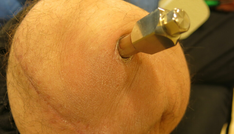 Bildet av stump med bolt. Pasienten er til oppstart av vektbæringsprotokoll 6 uker post operativt etter andre operasjon.