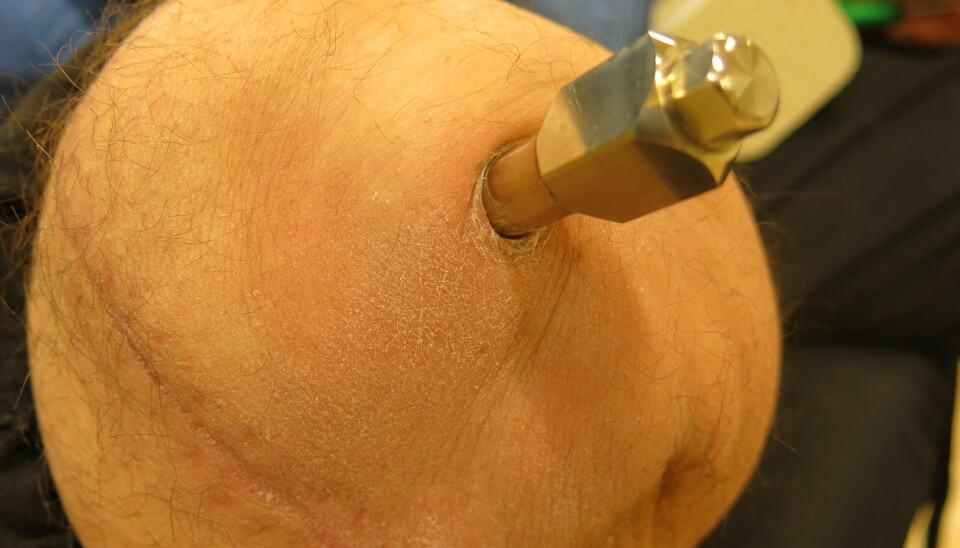 Bildet av stump med bolt. Pasienten er til oppstart av vektbæringsprotokoll 6 uker post operativt etter andre operasjon. Bildet av stump med bolt. Pasienten er til oppstart av vektbæringsprotokoll 6 uker post operativt etter andre operasjon.